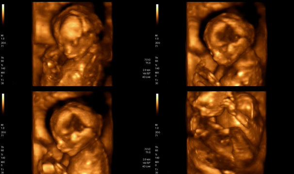 Best 3D 4D Pregnancy Scan In Chennai