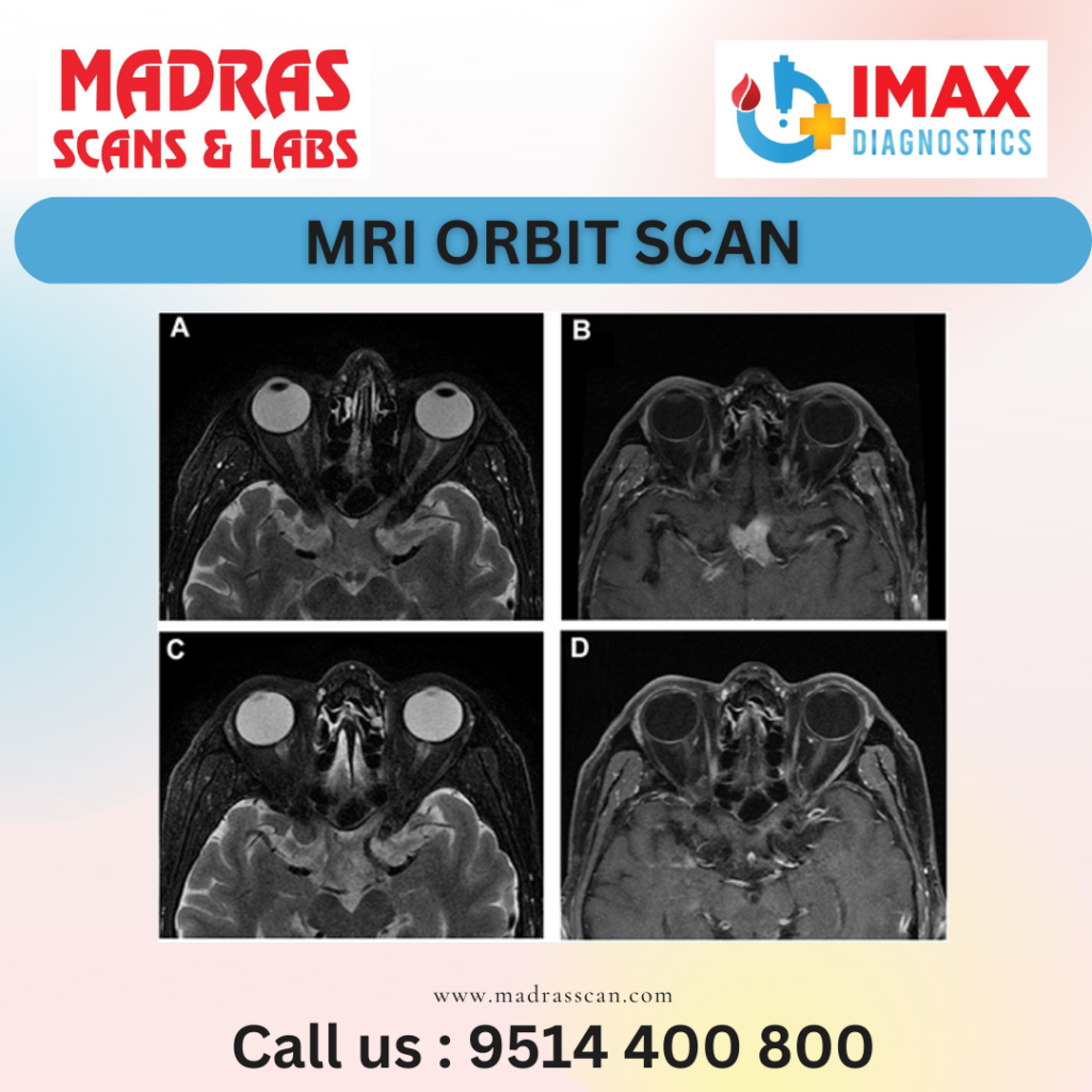 MRI Orbit Scan in chennai