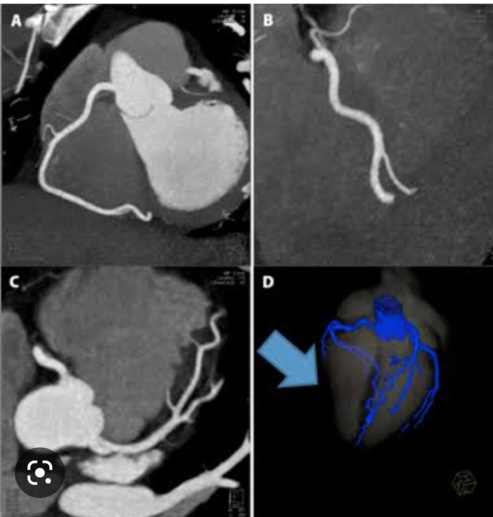 CT coronary angiography