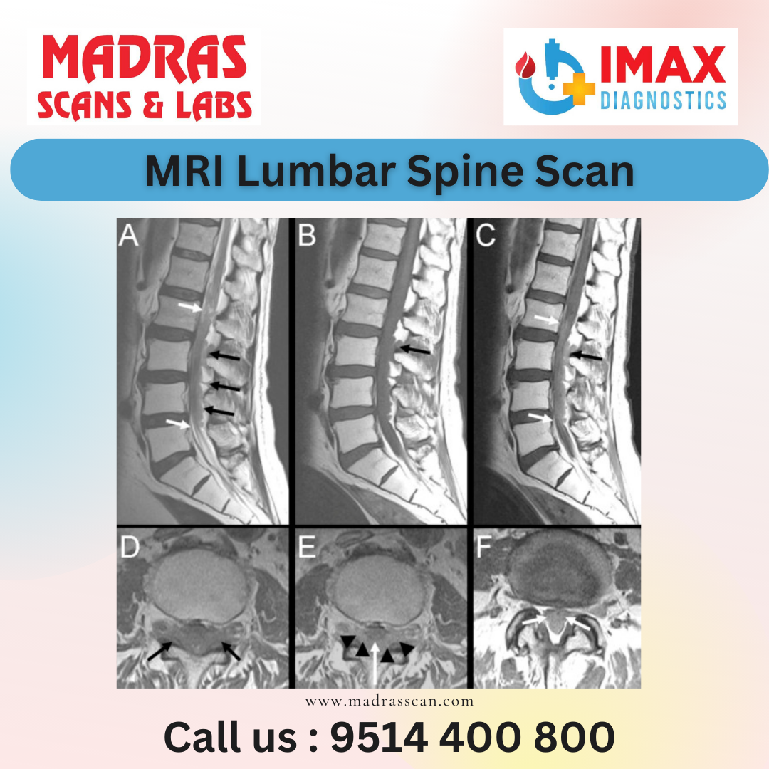 Mri Lumbar Spine Scan Benefits Madras Scans And Labs