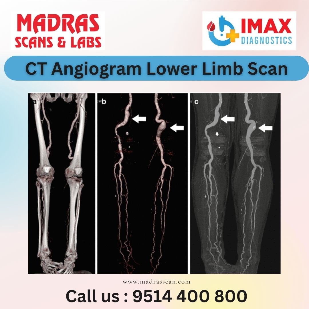 Ct Angiogram Scan In Chennai Madras Scans And Labs 0089