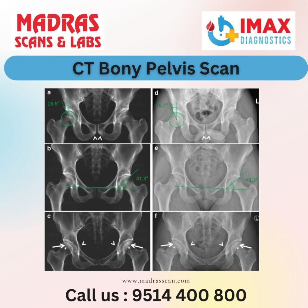 CT Bony Pelvis Scan