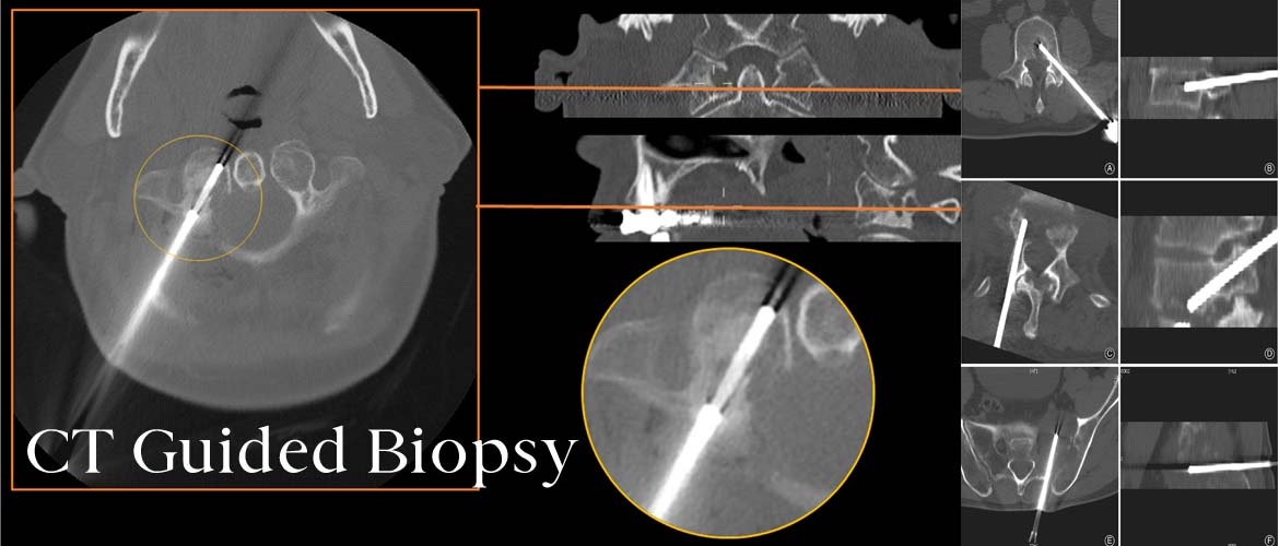 CT Guided Biopsy