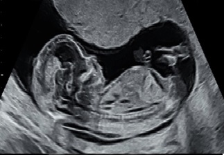 NUCHAL FOLD FOR MEASURING NT