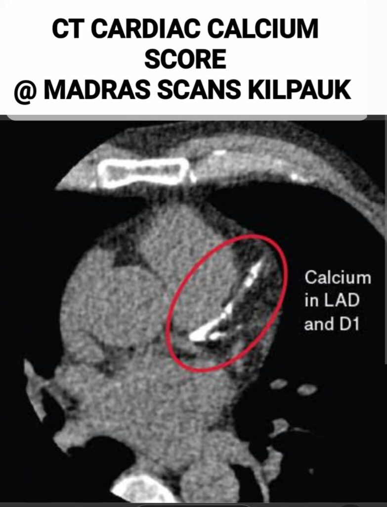 CT scan for calcium scoring